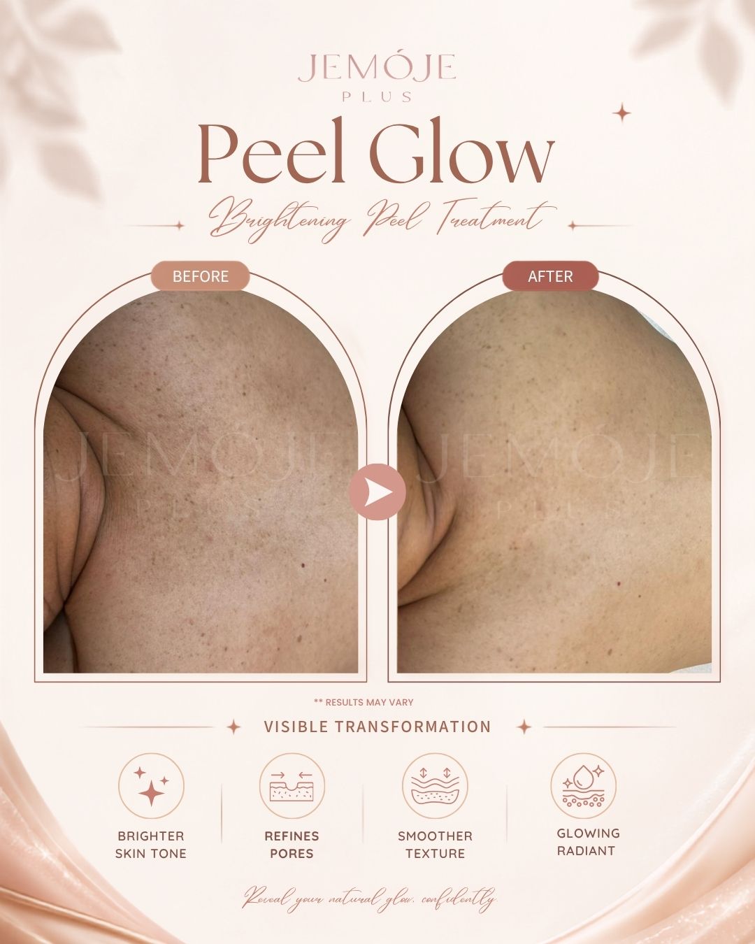 Peel Glow Treatment before and after result 1 at JEMOJE Plus Mid Valley Kuala Lumpur