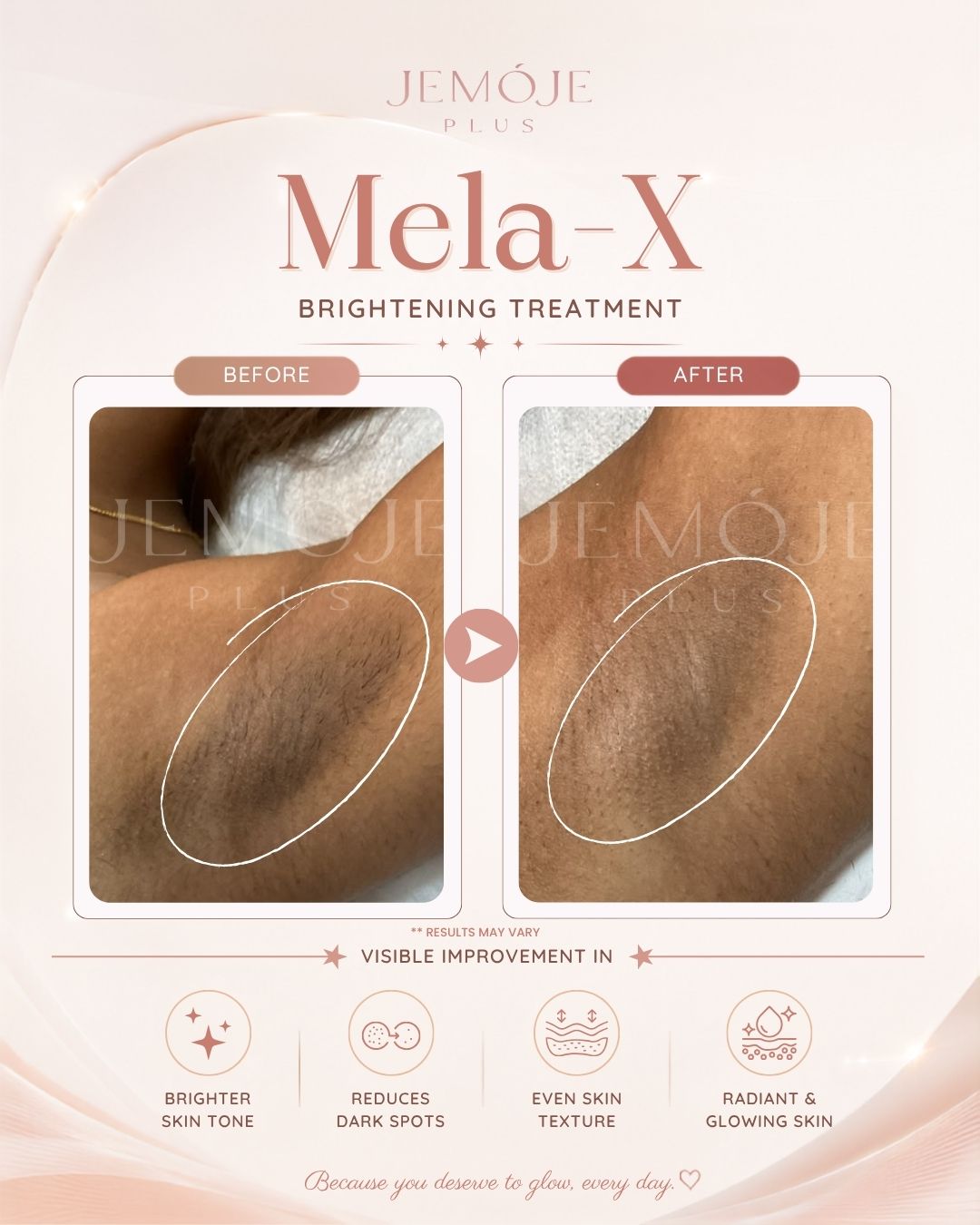 Mela-X Skin Brightening before and after result 1 at JEMOJE Plus Mid Valley Kuala Lumpur